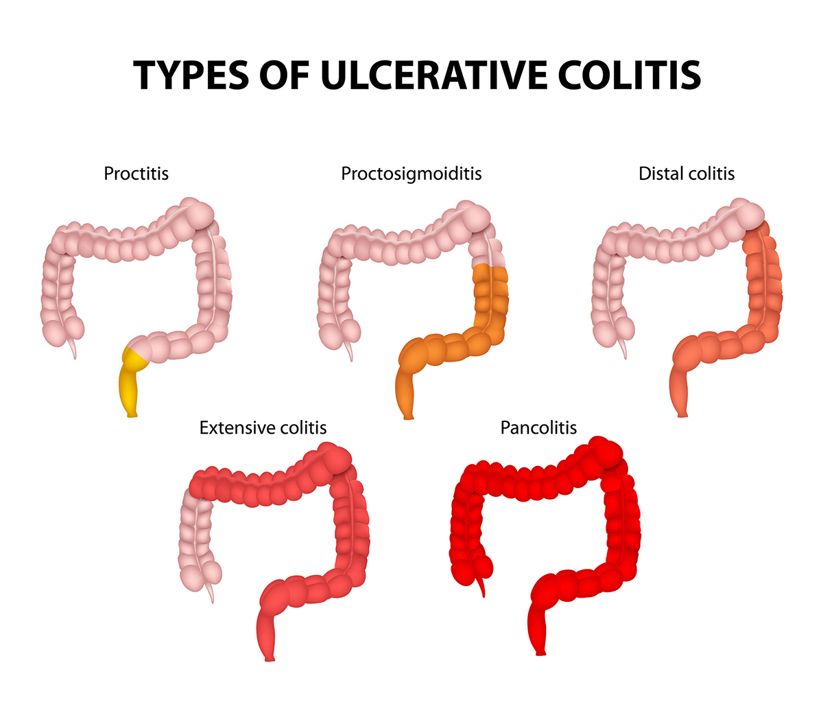 Types of Ulcerative Colitis. The diagram shows the types of UC, from the proctitis, (involving just the rectum), to the pancolitis, (involving the entire colon).